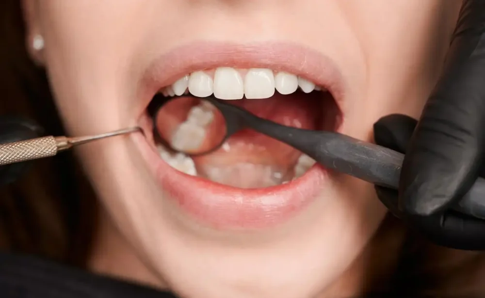 Tooth Coloured Fillings