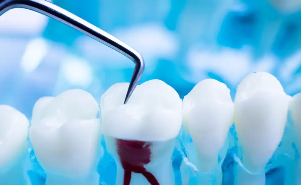 Root canal therapy