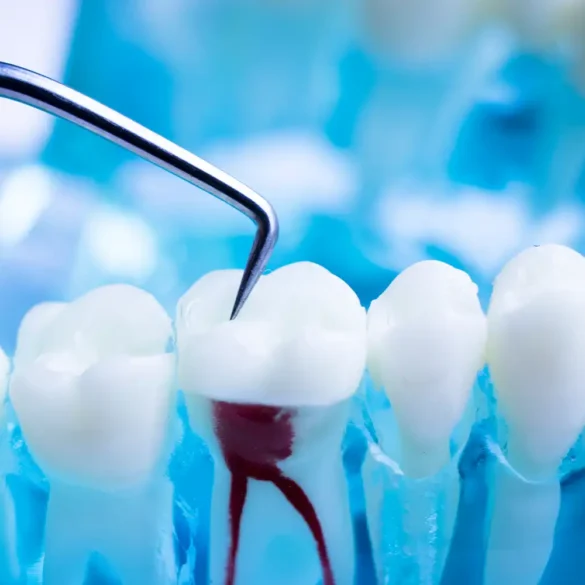 Root canal therapy