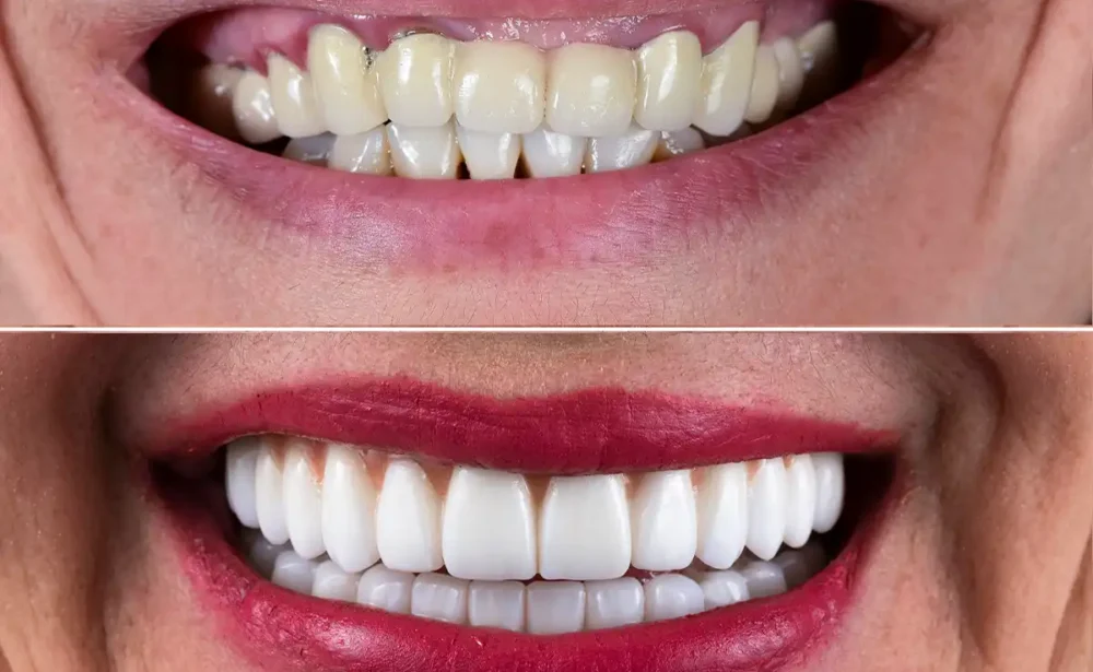 Smile restoration