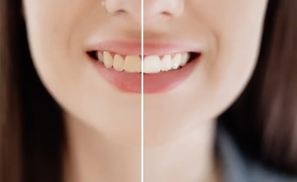 Teeth whitening