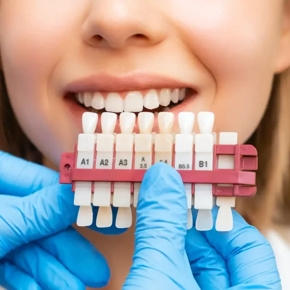 Veneers, Crowns & Bridges